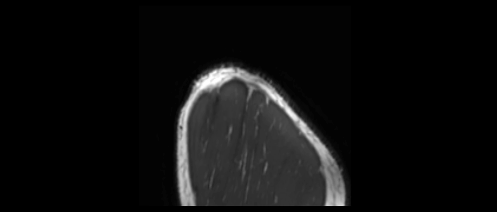 shoulder ligaments sagittal  cross sectional anatomy 3T MRI AI enhanced radiology image -img-00001-00060.webp